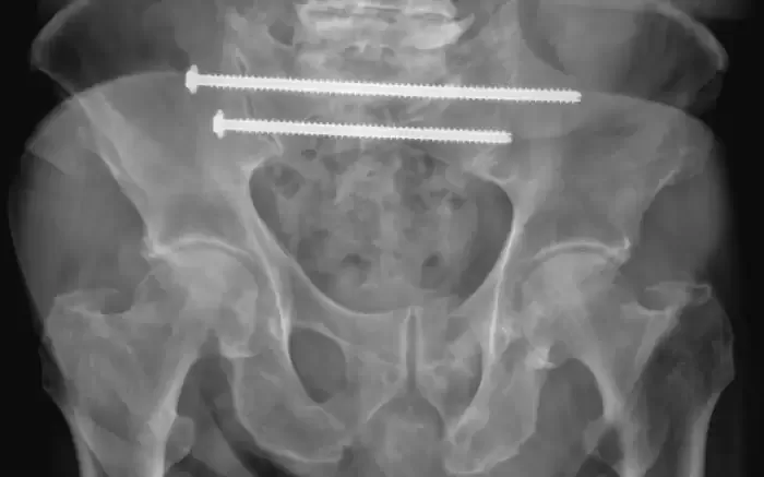 Röntgen Becken nach Implantation zweier 7.3 mm Schrauben quer durch das Becken und Kreuzbein.